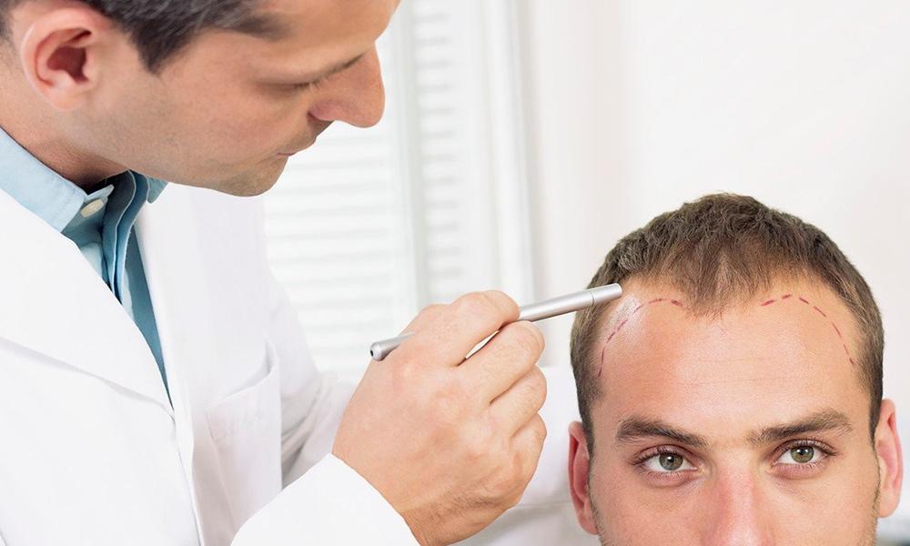 Hair Transplant